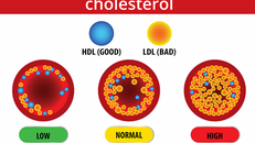 Thừa cholesterol xấu (LDL) rất nguy hiểm, dễ gây nhồi máu cơ tim, đột quỵ, tai biến,...