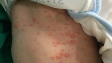 Bé trai ở Tuyên Quang chào đời mới 10 ngày đã bị thủy đậu