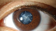 4 căn bệnh ở mắt nếu không chữa trị sớm có thể dẫn tới nguy cơ mù lòa