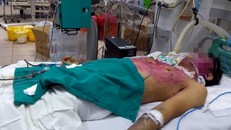 Dùng sai thuốc trị thủy đậu, thanh niên 28 tuổi nguy kịch