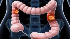 Tuyên Quang: 8 người trong một gia đình bị ung thư đại tràng 