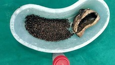 Hơn 4.000 viên sỏi trong túi mật một người đàn ông