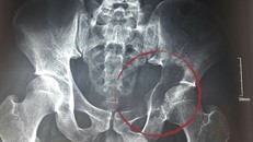 Khối u kích cỡ lớn phá huỷ ổ cối và xâm lấn cả vào ổ bụng