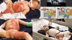 Bé 20 tháng bị bỏng toàn thân do ấm nước sôi dội vào người