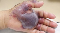 Bàn tay bị nhiễm trùng nặng do ăn hải sản sống của cụ ông Hàn Quốc. Ảnh: Asia One.