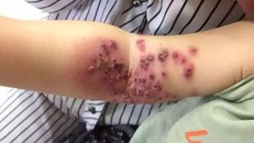 Bé 18 tháng tuổi sưng rộp, lở loét cánh tay vì nụ hôn của mẹ