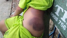 Bộ GD&ĐT yêu cầu báo cáo khẩn vụ học sinh lớp 1 nghi bị cô giáo đánh