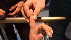 Kiến cắn vào ngón tay trái khiến bệnh nhân bị sốc phản vệ. Ảnh: BVCC