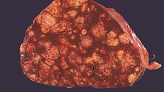 Không phải rượu bia, đây mới là sát thủ gây ung thư gan âm thầm cho người Việt