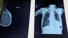 Phim chụp khối u của bệnh nhân. (Ảnh: PV/Vietnam+)