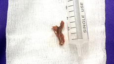 Xương cá nằm trong phế quản bệnh nhân được gắp ra. Ảnh: Hà Trang.