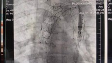 Kết quả can thiệp đặt stent graft động mạch chủ của bệnh nhân. (Ảnh: Mai Trang/TTXVN)