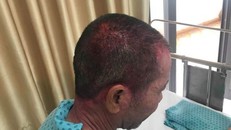 Thuốc nhuôm tóc khiến da đầu bị phỏng rộp lan xuống da mặt và cả phần cổ. Ảnh:BSCC