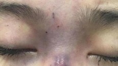 Bé gái 13 tuổi mù mắt vì tiêm filler nâng mũi