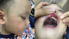 Cô giáo tát bé 3 tuổi bầm mặt, tụ máu môi