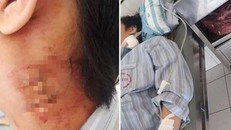 Nghi vấn Bệnh viện Nhiệt đới Trung ương, Bạch Mai chẩn đoán sai, mổ nhầm cho bệnh nhân