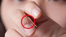 Nếu vô tình làm xước móng rô nặng hơn dễ gây đau, rát, khó chịu và ảnh hưởng đến sức khỏe, thậm chí là ung thư.