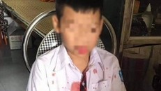 Cháu Kh. bị thương ở vùng mặt và tay sau khi bị Đức hành hung
