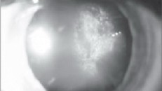 Đục thể thủy tinh dưới vỏ sau do steroid.