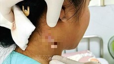 Vết áp xe trên cổ của bệnh nhân đang được tiếp tục theo dõi.