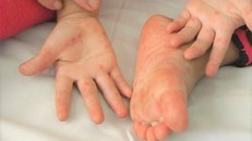 Số ca mắc tay chân miệng gia tăng, cảnh giác dịch lây lan 