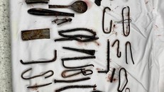 Khoảng 1 kg kim loại được lấy ra từ trong bụng của bệnh nhân. (Ảnh: Sức khoẻ & Đời sống)