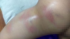 Hình ảnh chân bé gái 4 tuổi bị bầm tím. Ảnh: TTXVN