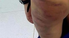 Vào thời điểm kiểm tra, cơ quan chức năng xác định trên người cháu L.M.T có khoảng 20 vết bầm tím do mẹ kế là bà H.M.N bạo hành. (Ảnh: TTXVN phát)