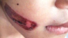 Vết bỏng trên mặt bé T.