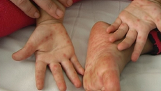 Cách phòng chống bệnh tay chân miệng