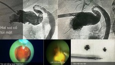 Tin vui cho người bệnh: Tán sỏi túi mật qua da bằng laser