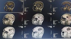 Hình ảnh CT , MRI sọ não kén sán não trước mổ - Ảnh: BVCC
