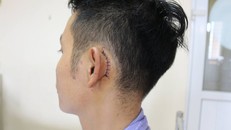 Anh T. được vá màng nhĩ sau tai nạn điện thoại phát nổ gây chấn thương (Ảnh: Bệnh viện cung cấp)