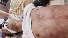 Dù được điều trị tích cực nhưng anh H. không qua khỏi.