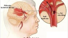 Đột quỵ não gây nguy hiểm cho tính mạng của người bệnh.