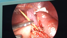 Cây tăm dài 6cm đâm vào lá lách bệnh nhân.