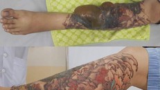 Hình ảnh bệnh nhân Q. bị bỏng nặng sau khi xóa hình xăm.