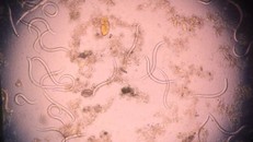 Hình ảnh giun lươn làm ổ trong cơ thể của một bệnh nhân.