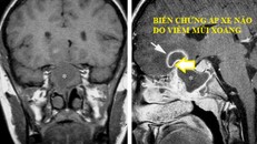 Viêm mũi xoang có thể gây ra những biến chứng nguy hiểm