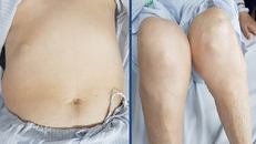 Bệnh nhân có biểu hiện teo cơ tứ chi, béo bụng, rạn da vùng bụng và suy tuyến vỏ thượng thận.