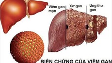Viêm gan B diễn tiến rất âm thầm, là nguyên nhân hàng đầu gây xơ gan, ung thư gan.