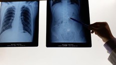 Hình ảnh dị vật là chiếc tai nghe không dây trong ổ bụng bệnh nhi tự kỷ.