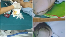 Hình ảnh cháu G.B sau phẫu thuật (ảnh GDCC)