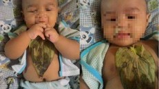 Bé gái bị bỏng nặng vì đắp lá trầu