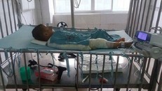 Ngã vào nồi bỗng rượu đang sôi, bé 3 tuổi nguy kịch