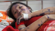 Miền Bắc bước vào đợt cao điểm của dịch thủy đậu