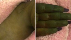 Da người và tay của Danni chuyển màu xanh sau khi bôi thuốc nhuộm. Ảnh: kennedynewsandmedia.co.uk. 