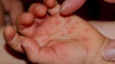 Bệnh chân - tay - miệng đang có dấu hiệu gia tăng