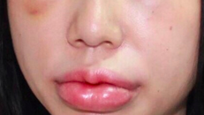 Hình ảnh bệnh nhân T.T.H bị biến chứng khi tiêm chất làm đầy (filler) ở môi, mắ