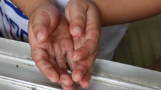 Đã có 6 trường hợp tử vong do bệnh tay chân miệng